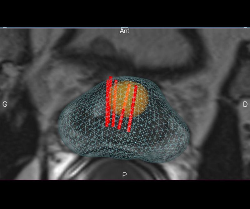 Elastyczna biopsja fuzyjna prostaty