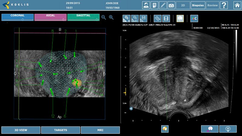 Elastyczna biopsja fuzyjna prostaty